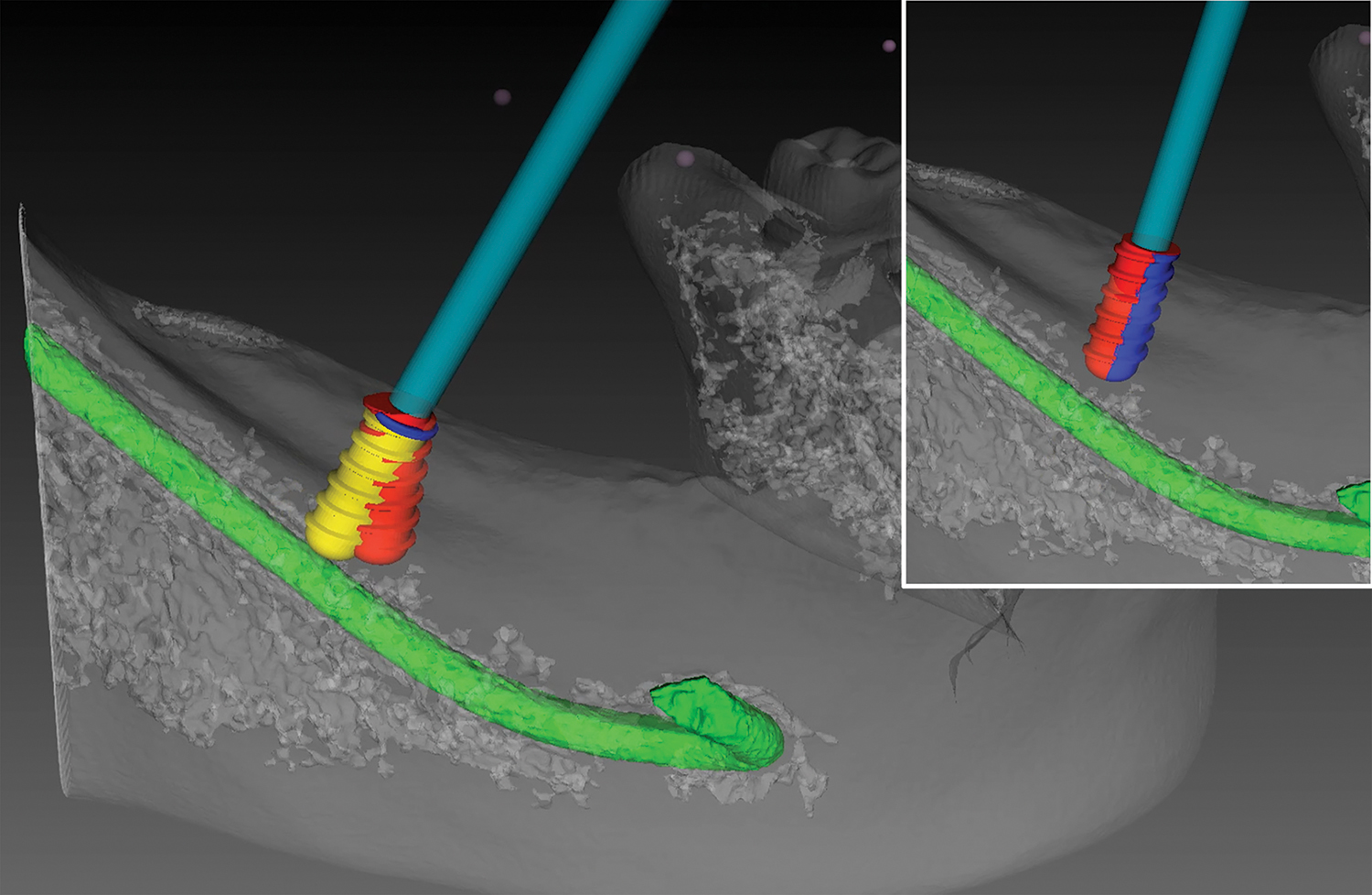 R&D - Screw-Free Fixation System
